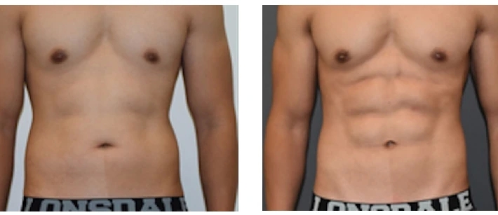 Exactly What Does The Liposuction treatment Approach Suggest? post thumbnail image