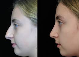 Discover how easy it is to request a Liquid nose job Beverly Hills post thumbnail image