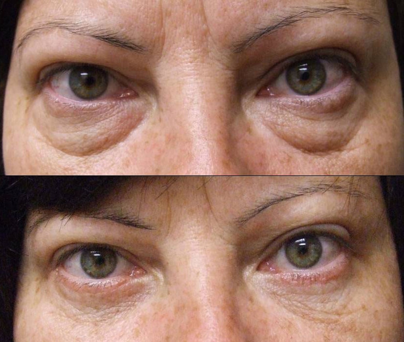All You Should Find Out About Blepharoplasty Santa Barbara post thumbnail image